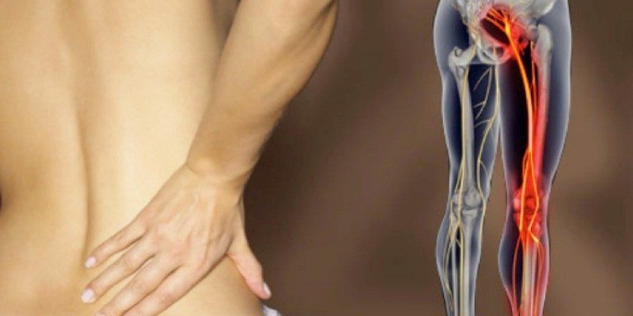 Informati Sulla Sciatalgia Cosè Quando Si Presenta E Come Si Cura Sanitaria Sportiva Blog 0813